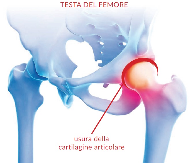 Dolore alle mani per colpa dell'artrosi? . Se hai altri problemi, famm